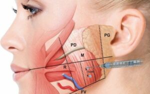 Botox for TMJ and Myofascial Pain